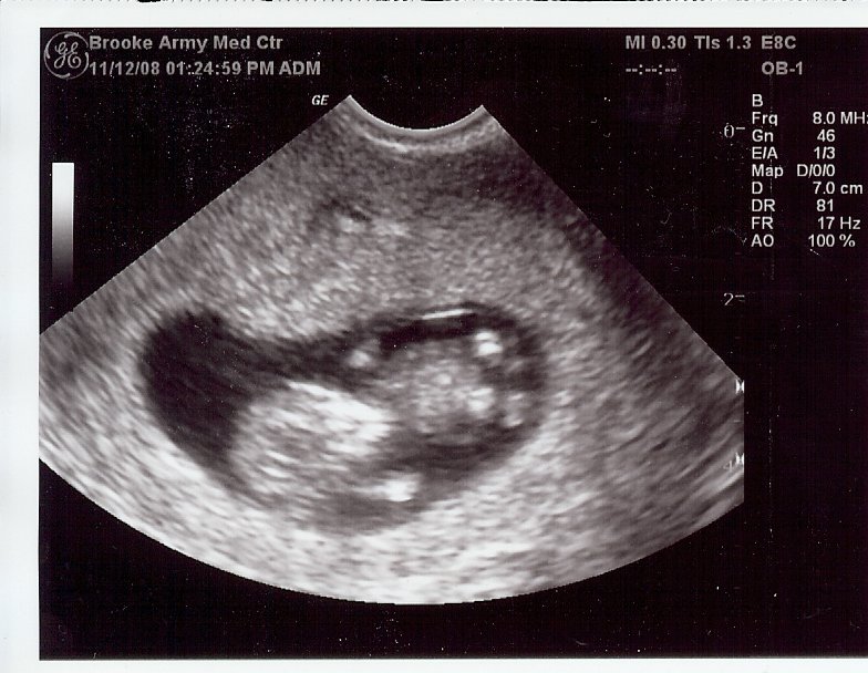Как выглядит плод на 6 неделе беременности фото узи